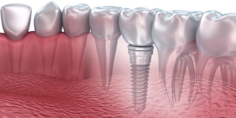 Yerli İmplant Nedir?